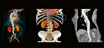 Комплексная томография (органы грудной клетки и брюшной полости)