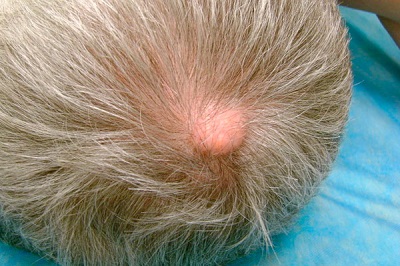 фиброма в волосистой части головы