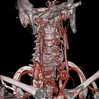 КТ ангиография брахиоцефальных артерий