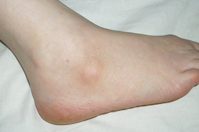 фиброма на ноге