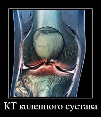 КТ коленного сустава
