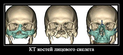 КТ костей лицевого скелета