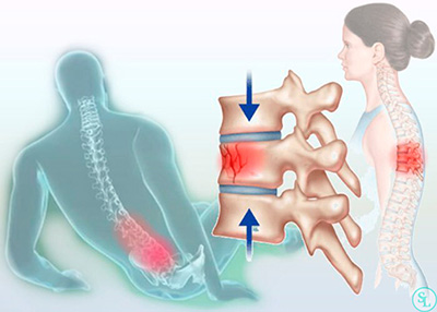 Последствия травм спины