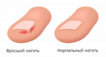 Онихокриптоз. Лечение вросшего ногтя в Киеве