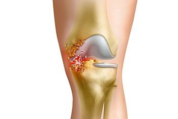 Почему болит колено сбоку: причины и способы лечения