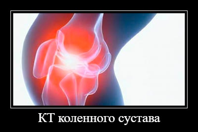 КТ коленного сустава